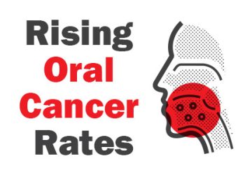 Torrance dentist, Dr. Bradley Miller at Miller Family Dental, talks about the process of screening for oral cancer as diagnosis rates are on the rise.